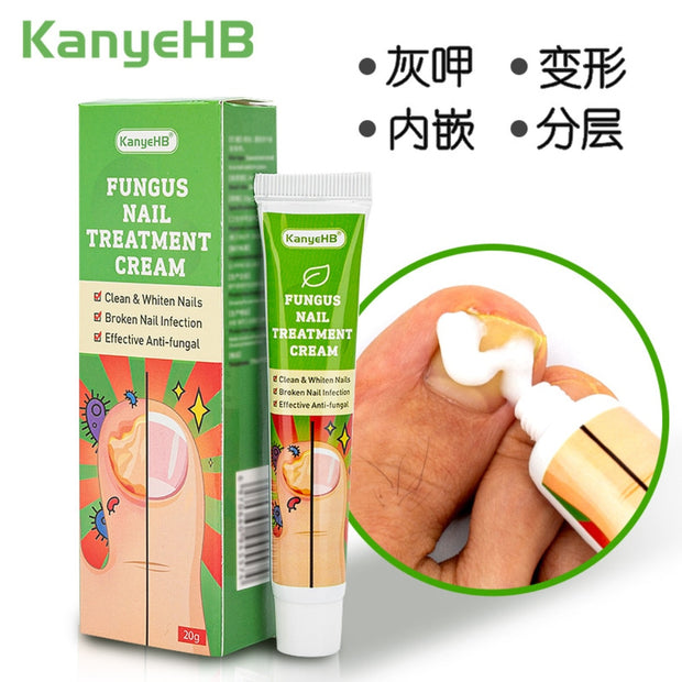 20g Nail Cream Fungus Treatment Cream Removal Nail Paronychia Ointment Feet Whitening