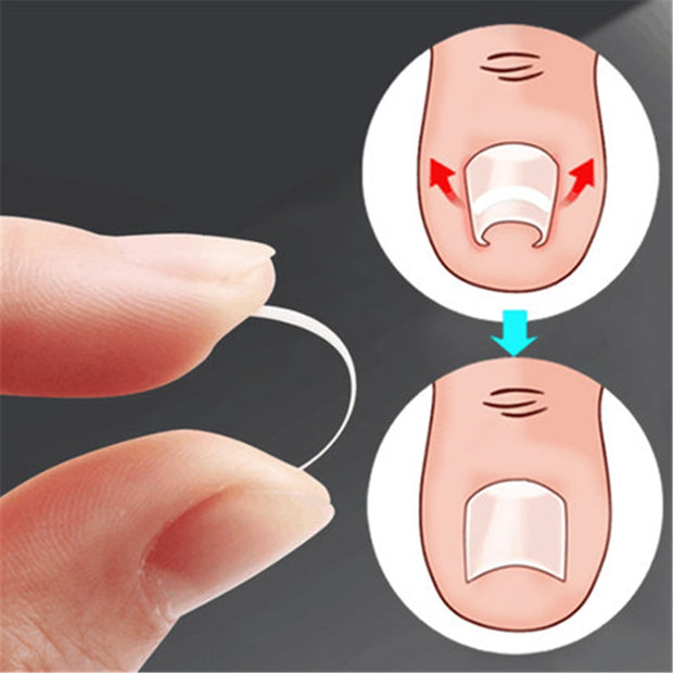 10pcs Ingrown Toenail Correction Tool Ingrown Toe Nail Treatment