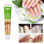 20g Nail Cream Fungus Treatment Cream Removal Nail Paronychia Ointment Feet Whitening