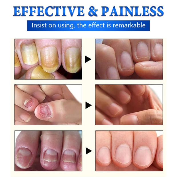 Jemeesen Fungal Nail Treatment Oil Foot Repair Essence