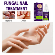 Nail Fungus Treatments Serum Foot Anti Paronychia Onychomycosis Repair